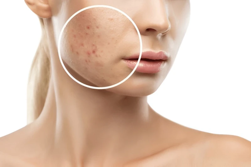 Which Skin Care is Best for Acne? Top Solutions for Clearer Skin